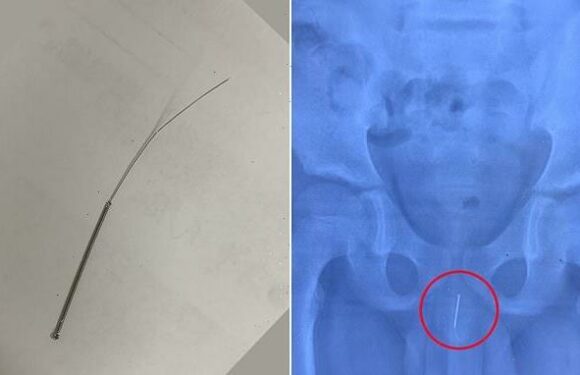 Chinese doctors discover 8cm acupuncture needle stuck up boy's penis