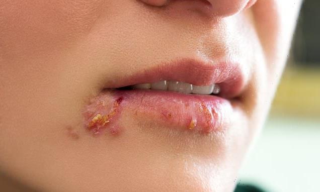 Genetically-engineered herpes virus can beat cancer, scientists find