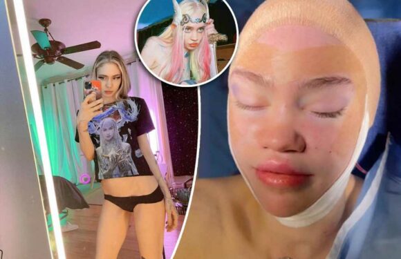 Grimes shares pic of bandaged face after saying she wanted ‘elf ear’ surgery