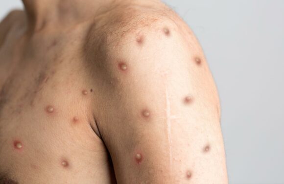 How to spot monkeypox rashes on different skin tones revealed | The Sun