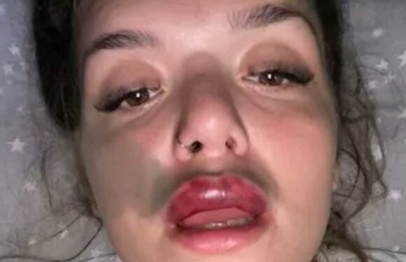I got lip filler but it went totally wrong – my lip was swollen and bruised but it didn’t stop me getting it done again | The Sun