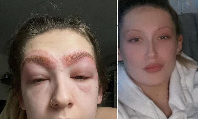 Mother suffered allergic reaction to Superdrug eyebrow tinting