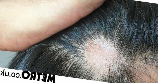 Baldness cure a step closer as scientists grow hair in a lab
