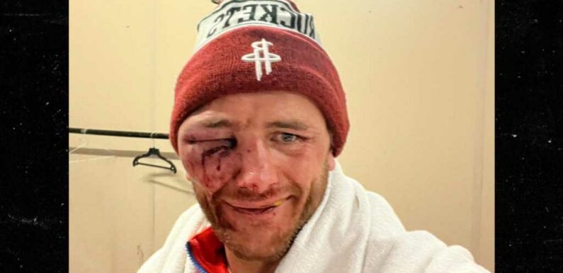 Bare Knuckle Boxing's Nathan Decastro Shows Gruesome Eye Injury After Fight