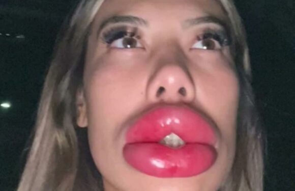 I ended up in hospital after having lip filler – I had no idea I was allergic, I’d had it done before | The Sun