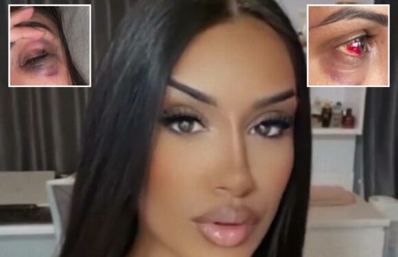 I got tear trough filler but the practitioner hit a nerve so it went badly wrong – please don't make the same mistake | The Sun