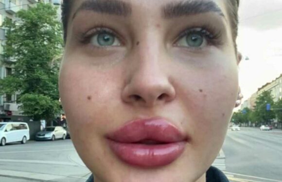 I love a big pout & am addicted to lip filler, I once even pumped 5ml in one go, trolls say it's too much but I love it | The Sun