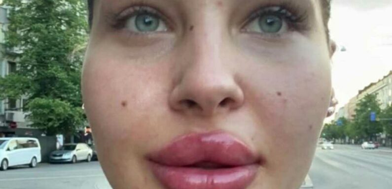 I love a big pout & am addicted to lip filler, I once even pumped 5ml in one go, trolls say it's too much but I love it | The Sun