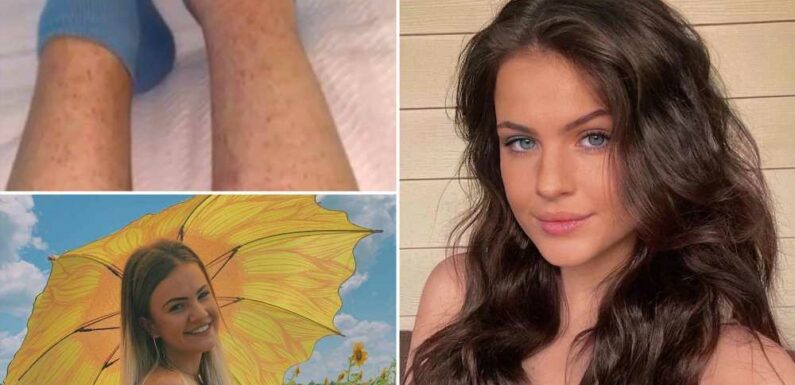 I thought my rash was harmless but I was minutes away from death – it was terrifying | The Sun