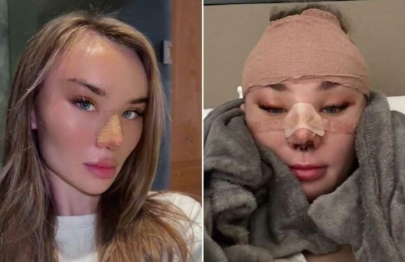I’m 22 and in love with surgery – people tell me to stop but I've spent over £10k on nose jobs, a face lift and more | The Sun