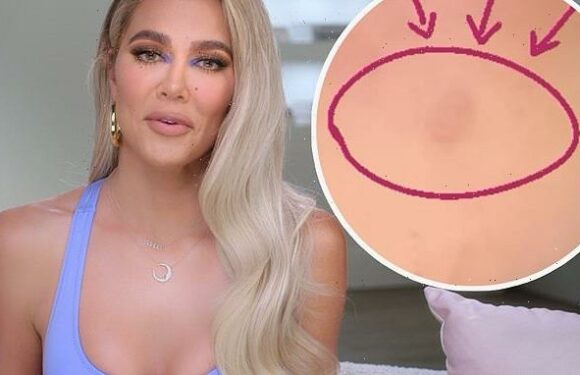 Khloe Kardashian reveals she had a TUMOR removed from her face