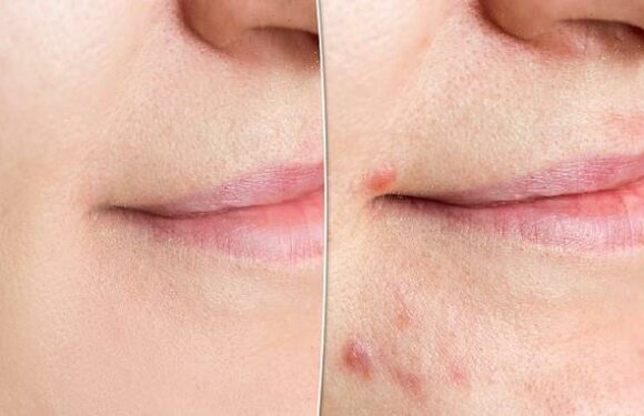 This blemish line helps clear flare-ups with game-changing results