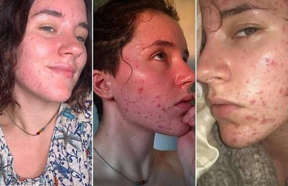 Trolls bully student with severe acne caused by high testosterone