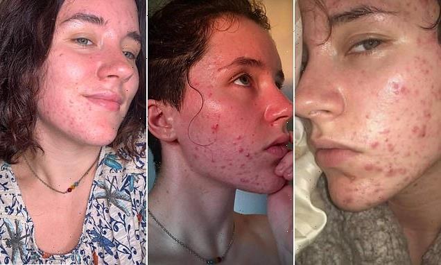 Trolls bully student with severe acne caused by high testosterone
