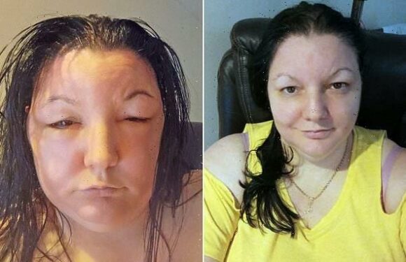 Woman embarrassed by greys shares severe reaction to Schwarzkopf dye