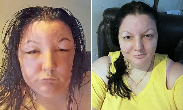 Woman embarrassed by greys shares severe reaction to Schwarzkopf dye