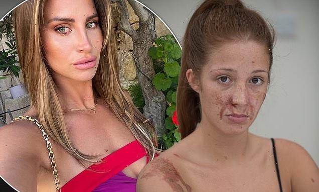 Ferne McCann blasted over 'insincere' apology by acid attack victim