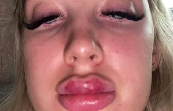 I got carried away with filler and ruined my face – my lips were so swollen I looked like I'd eaten a bee | The Sun