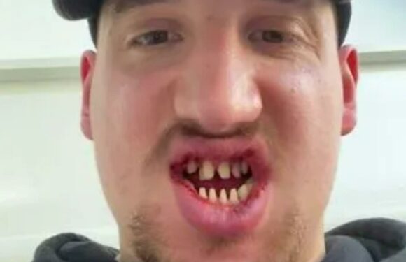 Man proudly shows off his new veneers – but people say they're so bright, they look like LED lights | The Sun