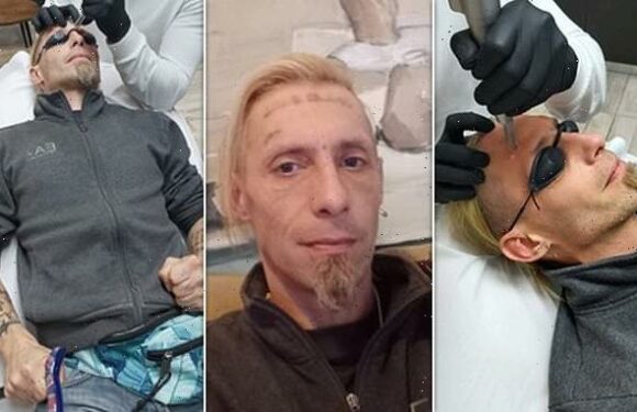 Homeless man paid by stag party to get a tattoo is having it removed