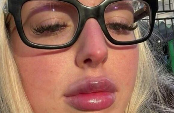 I finally got my 5ml lip filler dissolved… trolls say I still look the same but I don't care, I love my new pout | The Sun