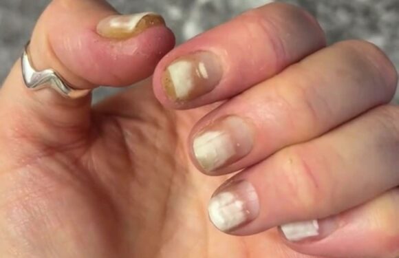 I tried to give myself a gel manicure but it went terribly wrong – I had an allergic reaction and my nails are ruined | The Sun