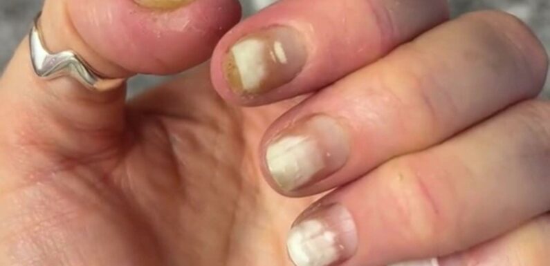 I tried to give myself a gel manicure but it went terribly wrong – I had an allergic reaction and my nails are ruined | The Sun