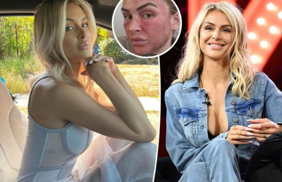 Lala Kent shows off red, bruised face following cosmetic procedure