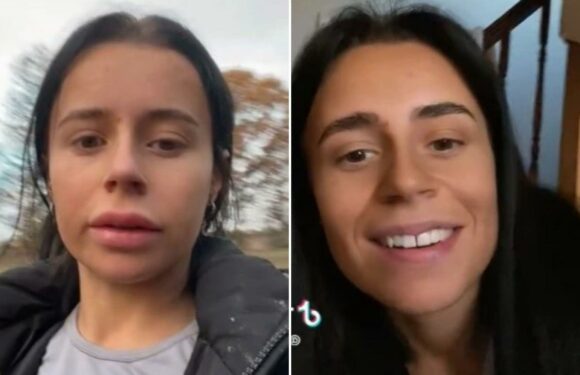 My lip filler migrated so much that I had it dissolved – now I can't look at myself in the mirror, I hate it so much | The Sun