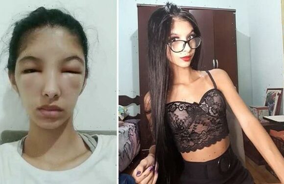 Teenager felt like a monster after allergic reaction to hair dye
