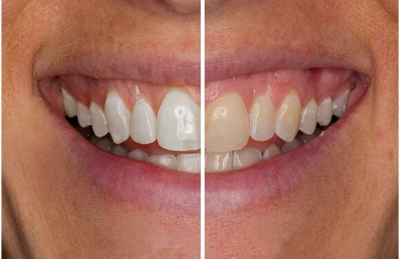 This Teeth Whitening Kit May Transform Your Smile in Just 3 Weeks