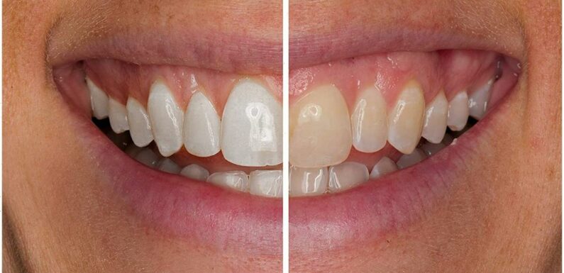 This Teeth Whitening Kit May Transform Your Smile in Just 3 Weeks