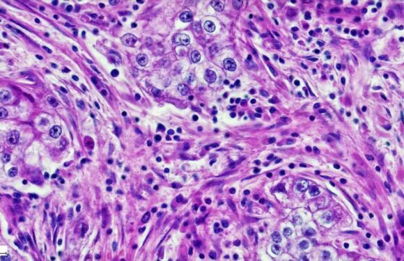What is adenocarcinoma? | The Sun