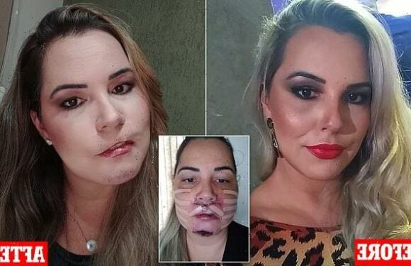 Woman left DEFORMED after botched knock-off filler procedure