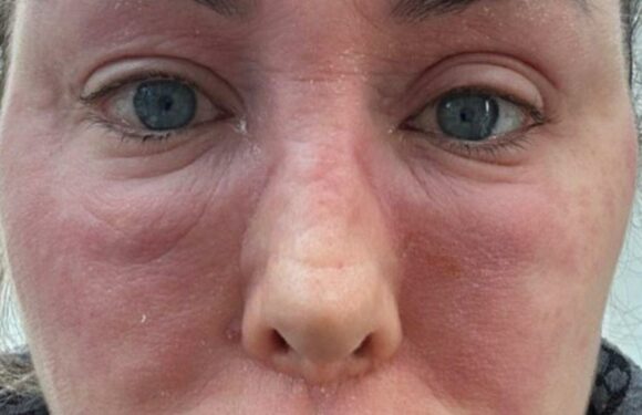 Ex On The Beach star rushed to hospital after suffering terrifying reaction