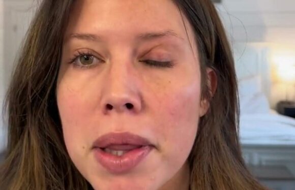 I got Botox to make my skin baby soft… it’s actually given me more wrinkles and my eyes are loads lower too | The Sun