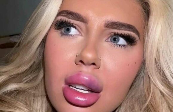 I had my lip fillers dissolved but I missed them so had them redone – people say I've got 'hot dog lips' but I love them | The Sun