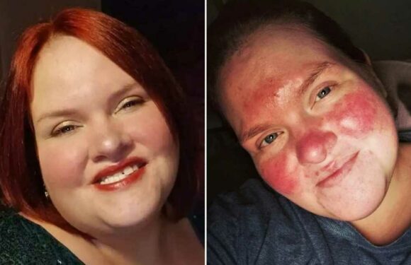 I was branded a tomato by cruel bully at work while strangers told me I was ugly – but now I've found a cure | The Sun