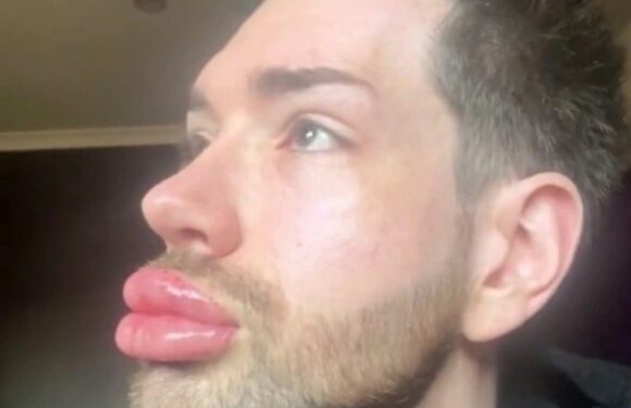 I'm known as the Plastic Botched Boy – I spent £32k on face filler but now I've had it all removed – I look so different | The Sun