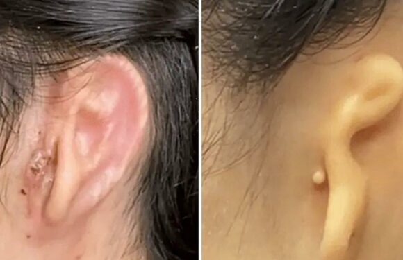 Medical breakthrough for woman whose doctors ‘printed off’ a new ear for her