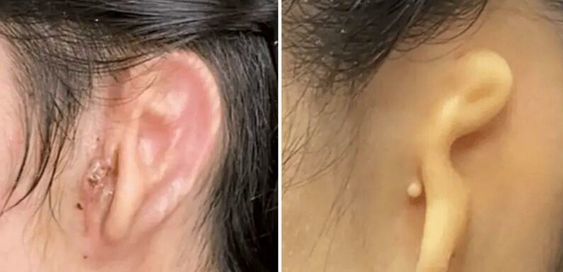 Medical breakthrough for woman whose doctors ‘printed off’ a new ear for her