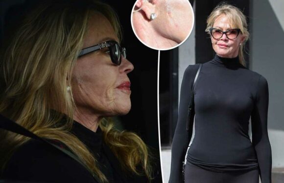 Melanie Griffith seen with new scar on her face years after skin cancer battle