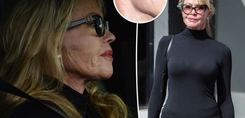 Melanie Griffith seen with new scar on her face years after skin cancer battle