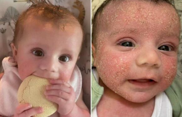 Parents rave over 'miracle' treatment that clears up baby's agonising eczema overnight | The Sun