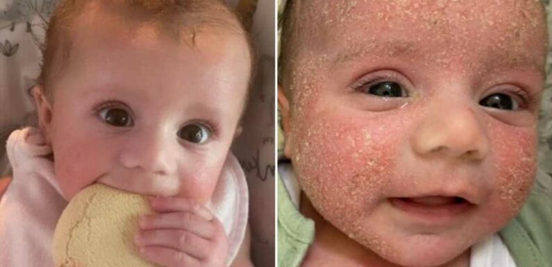 Parents rave over 'miracle' treatment that clears up baby's agonising eczema overnight | The Sun
