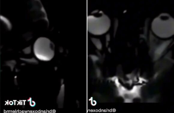 Shocking video reveals why you should never rub your eyes if you're tired | The Sun