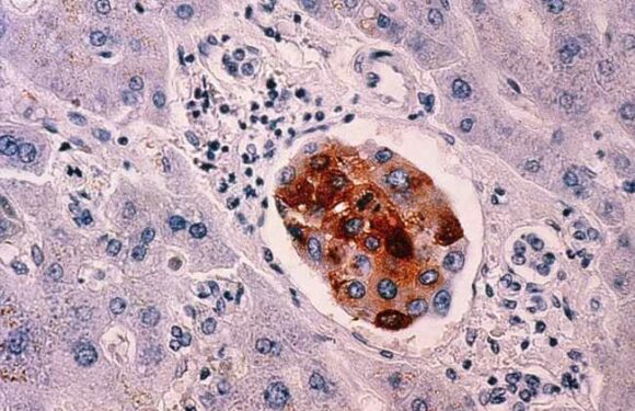 The surprising factor that raises your breast cancer risk – and 4 other risks you need to know | The Sun