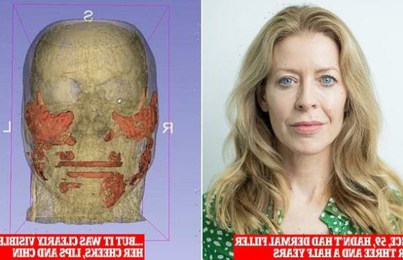 '20 years of filler stuck in my face': MRI reveals shocking truth