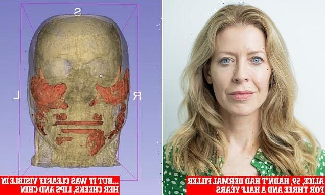 '20 years of filler stuck in my face': MRI reveals shocking truth