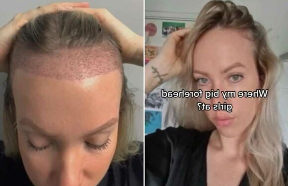 I hated my big forehead so I got a hair transplant to hide it, trolls say I shouldn’t have bothered but I love it | The Sun